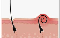 Lông mọc ngược, bài học cảnh giác ung thư hắc tố