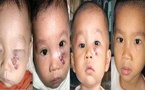 U máu, lành nhưng mệt