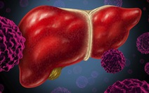 Điều trị tốt viêm gan B làm giảm tỷ lệ mắc ung thư gan