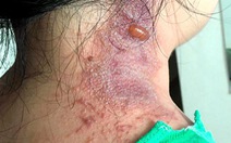 Nhiều bệnh nhân COVID-19 bị viêm da tiếp xúc do kiến ba khoang cắn