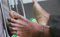 Quảng Ngãi: Bệnh viêm da dày sừng tay chân xuất hiện trở lại