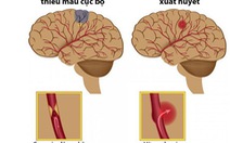 Những điều cần biết về đột quỵ não