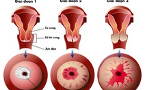 Sàng lọc phát hiện sớm ung thư cổ tử cung