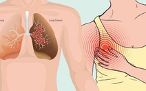 10 dấu hiệu cảnh báo sớm bệnh ung thư phổi