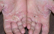 Bệnh tổ đĩa ở đôi bàn tay và đôi bàn chân