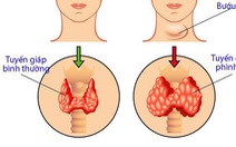 Bệnh bướu cổ có nên mổ?