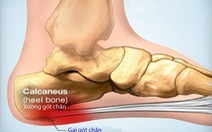 Gai xương gót chân