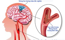 Không nên chủ quan với bệnh tai biến mạch máu não nhẹ