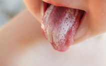 Những điều cần biết về bệnh nấm lưỡi ở trẻ em