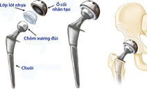 Thay khớp háng đường trước, có thể đi lại ngay hôm sau