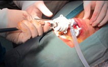 Lần đầu phẫu thuật nội soi cắt tuyến giáp không để lại sẹo