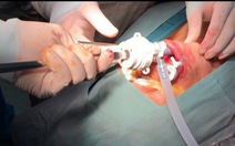 Phẫu thuật nội soi tuyến giáp qua đường miệng không để lại sẹo