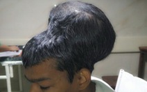 Ấn Độ cắt bỏ thành công cho bệnh nhân có khối u não 1,8kg