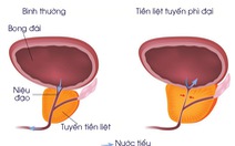 Phì đại tiền liệt tuyến