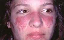 Lupus ban đỏ, căn bệnh nguy hiểm ít được biết đến