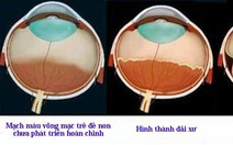 Giúp trẻ sinh non thoát khỏi nguy cơ mù lòa