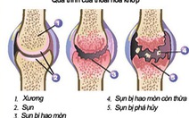 10 cách ngăn ngừa thoái hóa khớp