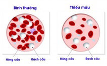 Hội chứng thiếu máu