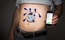 Xuất hiện thiết bị đeo IoT có thể chẩn đoán các bệnh về dạ dày