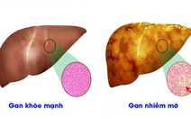 Hiểu đúng về bệnh gan nhiễm mỡ