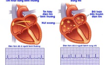 Rung nhĩ: Những điều người bệnh tim cần biết