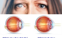 5 bệnh về mắt thường gặp ở người già