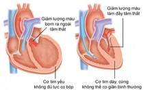 Những lưu ý trong điều trị suy tim