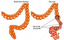 Chọn thuốc nhuận tràng cho người cao tuổi