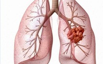 Ung thư phổi và các biện pháp phòng ngừa