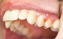 Các bệnh răng miệng thường gặp