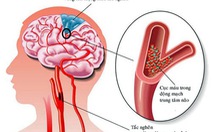 Dấu hiệu và cách xử trí cơn thiếu máu não thoáng qua