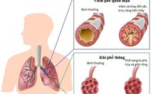 Ai có nguy cơ mắc bệnh phổi tắc nghẽn mạn tính?