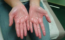 Lòng bàn tay thường xuyên bị ra mồ hôi