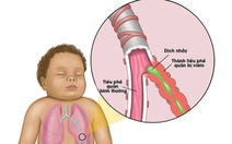 Bệnh viêm tiểu phế quản ở trẻ