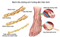 Bệnh thần kinh khu trú ở bệnh nhân đái tháo đường tuýp 2