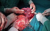 Bóc tách u lách “khủng” cho một bệnh nhân