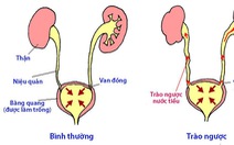 Bệnh trào ngược bàng quang - niệu quản ở trẻ em