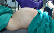 Phẫu thuật lấy khối u 25 kg từ bụng nam thanh niên