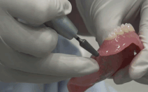 Video răng giả nằm trong thực quản bệnh nhân gần 4 năm