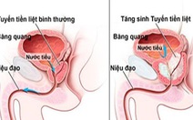 Đi tìm lời giải cho những băn khoăn khi chọn mua sản phẩm điều trị phì đại tuyến tiền liệt