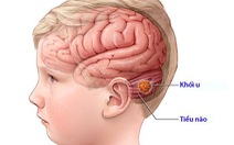 U tiểu não ở trẻ em