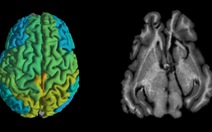 Kỹ thuật MRI mới giúp sớm phát hiện các căn bệnh thoái hóa thần kinh