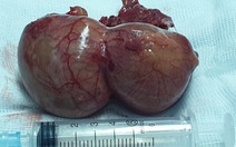 Phát hiện khối nang ngoài màng tim 'khủng'