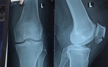 Bệnh nhân tử vong khi chữa gãy xương ở Bệnh viện STO Phương Đông