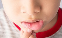 Nhận biết và xử trí bệnh lý niêm mạc miệng thường gặp ở trẻ em