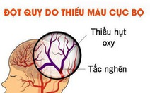 15-25% người đột quỵ sống ‘thực vật’, phụ thuộc hoàn toàn vào người khác