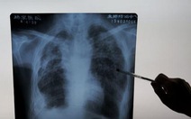 AI phát hiện COVID-19 từ ảnh X-quang phổi nhanh gấp 10 lần chuyên gia