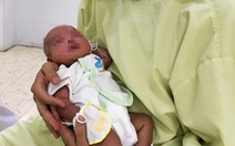 Cắt 19cm đại tràng cứu bé gái sinh non bị bệnh lý kép