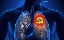 Phát triển phương pháp điều trị ung thư phổi mới đầy hứa hẹn