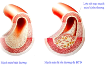 Biện pháp bảo vệ người tiểu đường trước đại dịch